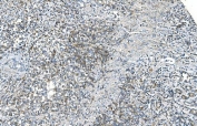 IHC staining of FFPE human gastric cancer with DR6 antibody. HIER: boil tissue sections in pH8 EDTA for 20 min and allow to cool before testing.