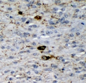 GAD2 Antibody Glioma IHC. Immunohistochemistry analysis of FFPE human glioma tissue stained with mouse monoclonal GAD2 Antibody clone 7G2 demonstrates focal cytoplasmic HRP-DAB brown staining within scattered neural-associated tumor cell populations, consistent with Glutamate decarboxylase 2 / GAD65-associated inhibitory neurotransmitter synthesis pathway expression. This Glutamate decarboxylase 2 antibody highlights GABAergic signaling-associated cellular regulation and neural differentiation biology within glioma tissue. HIER: boil tissue sections in pH8 EDTA for 20 min and allow to cool before testing.