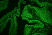 Immunofluorescent staining of FFPE human rectal cancer with HNRNPD antibody. HIER: boil tissue sections in pH8 EDTA for 20 min and allow to cool before testing.