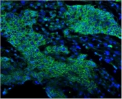 EGF Receptor Antibody for IF Lung Cancer Staining. Immunofluorescence analysis of FFPE human lung cancer tissue stained with EGF receptor antibody detecting EGFR (green). Tumor epithelial cells show strong membranous staining outlining cell borders with additional cytoplasmic signal, consistent with EGFR localization as a receptor tyrosine kinase and its trafficking following activation. The staining highlights malignant epithelial structures within the tumor microenvironment, while surrounding stromal areas show comparatively lower signal. DAPI nuclear stain (blue) highlights nuclei. HIER: boil tissue sections in pH 8 EDTA for 20 min and allow to cool before testing.