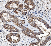 EGF Receptor Antibody Breast Cancer IHC. Immunohistochemistry staining of FFPE human breast cancer with EGF Receptor antibody. HIER: boil tissue sections in pH8 EDTA for 20 min and allow to cool before testing.