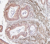 IRF3 Antibody Rectal Cancer IHC. Immunohistochemistry staining of FFPE human rectal cancer with IRF3 antibody. HIER: boil tissue sections in pH8 EDTA for 20 min and allow to cool before testing.
