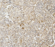 IRF3 Antibody Lung Cancer IHC. Immunohistochemistry staining of FFPE human lung cancer with IRF3 antibody. HIER: boil tissue sections in pH8 EDTA for 20 min and allow to cool before testing.