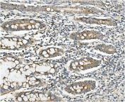 IHC staining of FFPE human rectal cancer with MMUT antibody. HIER: boil tissue sections in pH8 EDTA for 20 min and allow to cool before testing.