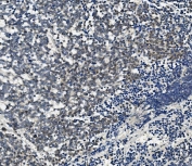 AHR Antibody Human Lung Cancer IHC. Immunohistochemical staining of FFPE human lung cancer demonstrates AHR expression using an AHR antibody. AHR, also known as Aryl Hydrocarbon Receptor and an Environmental Sensor Protein, is a ligand activated transcription factor that regulates xenobiotic metabolism, inflammatory signaling, and cellular responses to endogenous and environmental ligands. Predominantly nuclear and cytoplasmic staining is observed throughout malignant cells, consistent with active AHR signaling and the known involvement of this receptor in tumor progression and metabolic adaptation. Heat induced epitope retrieval was performed by boiling tissue sections in pH 8 EDTA buffer for 20 minutes followed by cooling prior to staining. These results support the utility of AHR Antibody for studies of toxicology, immune regulation, and lung cancer biology.