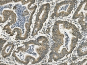 Gastrotropin Antibody Rectal Cancer IHC. Immunohistochemical staining of FFPE human rectal cancer demonstrates Gastrotropin expression using a Gastrotropin antibody. Gastrotropin, also known as Intestinal Lipid Binding Protein and FABP6, is an intracellular carrier involved in bile acid transport and lipid homeostasis. Predominantly cytoplasmic staining is observed in malignant glandular epithelial cells, consistent with the metabolic adaptations and altered bile acid signaling associated with colorectal tumor progression. Heat induced epitope retrieval was performed by boiling tissue sections in pH 8 EDTA buffer for 20 minutes followed by cooling prior to staining. These results support the utility of Gastrotropin Antibody for studies of bile acid metabolism, nutrient absorption, gastrointestinal physiology, and cancer biology.