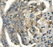 Immunohistochemistry analysis of LDL Receptor Antibody in human rectal cancer tissue. FFPE human rectal carcinoma demonstrates cytoplasmic and membranous HRP-DAB brown staining in tumor epithelial cells, consistent with LDL receptor (LDLR) expression involved in lipid uptake and metabolic activity, while surrounding stromal cells show lower staining intensity. Antigen retrieval was performed by boiling tissue sections in EDTA buffer, pH 8.0, for 20 minutes followed by cooling prior to incubation with LDL Receptor antibody.