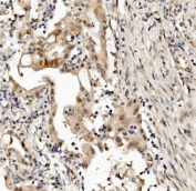 IHC staining of FFPE human rectal cancer with MED4 antibody. HIER: boil tissue sections in pH8 EDTA for 20 min and allow to cool before testing.