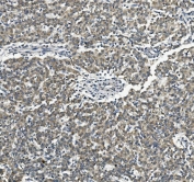 IHC staining of FFPE liver cancer with Vinexin antibody. HIER: boil tissue sections in pH8 EDTA for 20 min and allow to cool before testing.
