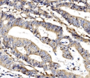 MC4-R Antibody Human Rectal Cancer IHC. Immunohistochemistry staining of FFPE human rectal cancer tissue using MC4-R antibody demonstrates moderate cytoplasmic and membranous staining within malignant gland-forming epithelial cells, consistent with expression of Melanocortin Receptor 4 (MC4-R). MC4-R is a G protein-coupled receptor that mediates melanocortin signaling pathways involved in energy homeostasis, neuroendocrine communication, and metabolic regulation. The observed staining pattern is consistent with the expected localization of a membrane-associated receptor and supports the utility of MC4-R antibody for studies of receptor-mediated signaling, endocrine regulation, and melanocortin pathway biology. HIER: boil tissue sections in pH8 EDTA for 20 min and allow to cool before testing.