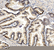 Immunohistochemical staining using NDRG1 antibody on paraffin-embedded human prostate cancer tissue sections. Heat-induced epitope retrieval was performed using EDTA buffer (pH 8.0) prior to antibody incubation. Sections were blocked with 10% goat serum and incubated with rabbit anti-NDRG1 antibody at 2 micrograms per milliliter overnight at 4C. Detection was carried out using a peroxidase-conjugated goat anti-rabbit IgG secondary antibody and DAB as the chromogen. Nuclei were counterstained with hematoxylin.