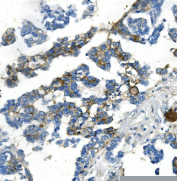 Immunohistochemical staining using NDRG1 antibody on paraffin-embedded human ovarian cancer tissue sections. Heat-induced epitope retrieval was performed using EDTA buffer (pH 8.0) prior to antibody incubation. Sections were blocked with 10% goat serum and incubated with rabbit anti-NDRG1 antibody at 2 micrograms per milliliter overnight at 4C. Detection was carried out using a peroxidase-conjugated goat anti-rabbit IgG secondary antibody and DAB as the chromogen. Nuclei were counterstained with hematoxylin.