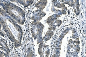 IHC staining of FFPE human rectal cancer with SLBP/Stem-Loop Binding Protein antibody. HIER: boil tissue sections in pH8 EDTA for 20 min and allow to cool before testing.