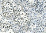 ATF1 Antibody Human Lung Cancer IHC. Immunohistochemical analysis of ATF1 Antibody / Activating Transcription Factor 1 Antibody in FFPE human lung cancer tissue following heat-induced antigen retrieval in pH 8 EDTA buffer. The section was incubated with ATF1 antibody at 1 ug/ml and detected using a biotinylated secondary antibody with streptavidin-biotin complex and DAB chromogen. Positive nuclear staining is observed in lung cancer cells, consistent with the transcriptional activity of ATF1. This ATF1 Antibody, an Activating Transcription Factor 1 antibody, is suitable for investigating transcriptional regulation, cellular signaling and cancer biology.