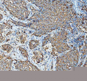 Immunohistochemical staining of FFPE human invasive adenocarcinoma of the lung tissue with Mucin 1 antibody, HRP-secondary and DAB substrate. HIER: boil tissue sections in pH8 EDTA for 20 min and allow to cool before testing.
