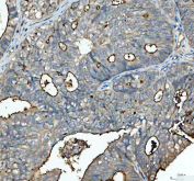 Immunohistochemical staining of FFPE human endometrioid adenocarcinoma tissue with Mucin 1 antibody, HRP-secondary and DAB substrate. HIER: boil tissue sections in pH8 EDTA for 20 min and allow to cool before testing.