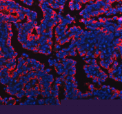 Immunofluorescent staining of FFPE human lung adenocarcinoma tissue with Mucin 1 antibody (red) and DAPI nuclear stain (blue). HIER: steam section in pH8 EDTA buffer for 20 min.