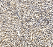 GRID2 Antibody Glioma Tissue IHC. Immunohistochemistry staining of FFPE human glioma tissue with GRID2 antibody. HIER: boil tissue sections in pH8 EDTA for 20 min and allow to cool before testing.