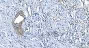 IHC staining of FFPE human renal carcinoma with GNG2 antibody. HIER: boil tissue sections in pH8 EDTA for 20 min and allow to cool before testing.