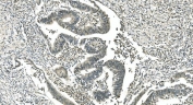 IHC staining of FFPE human rectal cancer with LSM5 antibody. HIER: boil tissue sections in pH8 EDTA for 20 min and allow to cool before testing.