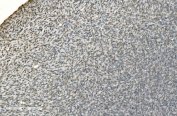 IHC staining of FFPE human skin cancer with LSM7 antibody. HIER: boil tissue sections in pH8 EDTA for 20 min and allow to cool before testing.
