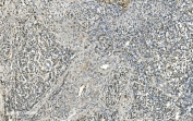 IHC staining of FFPE human gastric cancer with LSM7 antibody. HIER: boil tissue sections in pH8 EDTA for 20 min and allow to cool before testing.