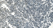 PI16 / Peptidase inhibitor 16 antibody in human testicular cancer by immunohistochemistry. Formalin-fixed paraffin-embedded human testicular cancer tissue stained with PI16 antibody shows cytoplasmic HRP-DAB chromogenic signal in tumor cells. Positive cells display granular cytoplasmic staining within the tumor cell population. Heat induced epitope retrieval was performed by boiling tissue sections in pH 8 EDTA buffer for 20 minutes followed by cooling prior to antibody incubation.