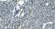 PI16 Antibody in human bladder cancer by immunohistochemistry. Formalin-fixed paraffin-embedded human bladder cancer tissue stained with PI16 / Peptidase inhibitor 16 antibody shows HRP-DAB chromogenic staining in tumor epithelial cells and surrounding stromal components. Positive cells display cytoplasmic signal within malignant epithelial nests embedded in fibrous stroma, while adjacent stromal cells exhibit variable staining intensity. Heat induced epitope retrieval was performed by boiling tissue sections in pH 8 EDTA buffer for 20 minutes followed by cooling prior to antibody incubation.