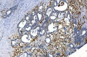 GCHFR Antibody Rectal Cancer IHC. Immunohistochemistry analysis of FFPE human rectal cancer tissue stained with GCHFR Antibody demonstrates granular cytoplasmic HRP-DAB brown staining throughout gland-forming tumor epithelial cellular populations, consistent with expression of GTP cyclohydrolase I feedback regulator / GCHFR in tetrahydrobiopterin-associated metabolic signaling and nitric oxide regulatory pathways. The observed staining pattern aligns with the intracellular metabolic regulatory function of this BH4-associated feedback protein in proliferative epithelial tissue environments. HIER: boil tissue sections in pH 8 EDTA for 20 min and allow to cool before testing.