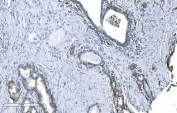 GCHFR Antibody Prostate Cancer IHC. Immunohistochemistry analysis of FFPE human prostate cancer tissue stained with GCHFR Antibody demonstrates cytoplasmic HRP-DAB brown staining within glandular tumor epithelial cellular populations, consistent with the role of GTP cyclohydrolase I feedback regulator / GCHFR in tetrahydrobiopterin metabolism and nitric oxide-associated metabolic regulation pathways. The observed staining profile aligns with the intracellular cofactor regulatory biology of GCHFR within epithelial-associated tissue compartments. HIER: boil tissue sections in pH 8 EDTA for 20 min and allow to cool before testing.