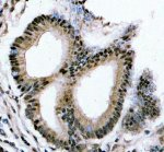YTHDC1 Antibody Human Colon Adenocarcinoma IHC. Immunohistochemical analysis of YTHDC1 Antibody / Nuclear m6A Reader Protein Antibody in FFPE human colon adenocarcinoma tissue. Following heat-induced epitope retrieval in pH 8.0 EDTA buffer, sections were stained with YTHDC1 antibody at 2 ug/ml and detected using an HRP-conjugated secondary antibody with DAB chromogen. Distinct nuclear staining is observed in the neoplastic glandular epithelial cells, consistent with the predominantly nuclear localization of YTHDC1 as an m6A RNA reader involved in RNA processing and gene expression. This YTHDC1 Antibody, a Nuclear m6A Reader Protein Antibody, is well suited for studies of epitranscriptomic regulation and YTHDC1 expression in colorectal cancer.
