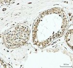 YTHDC1 Antibody Human Testicular Cancer IHC. Immunohistochemical analysis of YTHDC1 Antibody / Nuclear m6A Reader Protein Antibody in FFPE human testicular cancer tissue. Following heat-induced epitope retrieval in pH 8.0 EDTA buffer, sections were stained with YTHDC1 antibody at 2 ug/ml and detected using an HRP-conjugated secondary antibody with DAB chromogen. Predominantly nuclear staining is observed in the neoplastic cells, with weaker cytoplasmic staining in some areas, consistent with the primary nuclear localization of YTHDC1 and its role as an m6A RNA reader involved in RNA processing and gene regulation. This YTHDC1 Antibody, a Nuclear m6A Reader Protein Antibody, is well suited for investigating epitranscriptomic regulation and YTHDC1 expression in testicular cancer tissues.