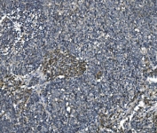 IHC staining of FFPE human lung cancer with EFT1 antibody. HIER: boil tissue sections in pH8 EDTA for 20 min and allow to cool before testing.