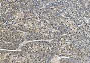 IHC staining of FFPE human liver cancer with CA1 antibody. HIER: boil tissue sections in pH8 EDTA for 20 min and allow to cool before testing.