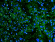 Immunofluorescent staining of FFPE human liver cancer with Cadherin 2 antibody (green) and DAPI nuclear stain (blue). HIER: boil tissue sections in pH8 EDTA for 20 min and allow to cool before testing.