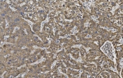 IHC staining of FFPE human liver cancer with Cadherin 2 antibody. HIER: boil tissue sections in pH8 EDTA for 20 min and allow to cool before testing.