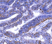 Claudin 7 Antibody Rectal Cancer Tissue IHC. Immunohistochemistry analysis of FFPE human rectal cancer stained with Claudin 7 Antibody demonstrates strong HRP-DAB brown membranous staining in tumor epithelial cells consistent with tight junction distribution, with mild cytoplasmic signal and low background in adjacent stromal tissue; antigen retrieval was performed in pH 8 EDTA buffer.