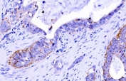 Claudin 7 Antibody Gallbladder Adenocarcinoma Tissue IHC. Immunohistochemistry analysis of FFPE human gallbladder adenocarcinoma stained with Claudin 7 Antibody demonstrates HRP-DAB brown membranous staining in tumor epithelial cells consistent with tight junction localization, with focal cytoplasmic signal and low background in surrounding stromal tissue; antigen retrieval was performed in pH 8 EDTA buffer.