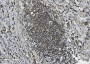 PARP1 Antibody Stomach Adenocarcinoma IHC. Immunohistochemistry analysis of FFPE human poorly differentiated stomach adenocarcinoma tissue using PARP1 antibody. Tumor cell nuclei demonstrate strong HRP-DAB brown staining consistent with the chromatin-associated localization of PARP1 in DNA repair, genomic instability adaptation, and nuclear stress-response signaling pathways active in poorly differentiated gastric carcinoma tissue. Nuclei are counterstained blue. Heat-induced epitope retrieval was performed by boiling tissue sections in pH8 EDTA buffer for 20 minutes followed by cooling prior to staining.
