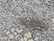 PARP1 Antibody Diffuse Gastric Adenocarcinoma IHC. Immunohistochemistry analysis of FFPE human poorly differentiated stomach adenocarcinoma tissue using PARP1 antibody. Tumor cell nuclei demonstrate widespread HRP-DAB brown staining consistent with the chromatin-associated activity of PARP1 in DNA strand break repair, genomic maintenance, and nuclear stress-response signaling pathways within aggressive gastric carcinoma tissue. Nuclei are counterstained blue. Heat-induced epitope retrieval was performed by boiling tissue sections in pH8 EDTA buffer for 20 minutes followed by cooling prior to staining.