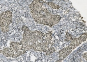 PARP1 Antibody Breast Cancer IHC. Immunohistochemistry analysis of FFPE human breast cancer tissue using PARP1 antibody. Tumor cell nuclei demonstrate diffuse HRP-DAB brown staining consistent with the chromatin-associated activity of PARP1 in DNA repair, genomic stability maintenance, and nuclear stress-response signaling pathways within proliferative breast carcinoma tissue. Nuclei are counterstained blue. Heat-induced epitope retrieval was performed by boiling tissue sections in pH8 EDTA buffer for 20 minutes followed by cooling prior to staining.