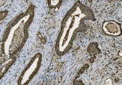 Poly (ADP-ribose) polymerase 1 Antibody Gallbladder Adenocarcioma IHC. Immunohistochemistry staining of FFPE human gallbladder adenocarcinoma with Poly (ADP-ribose) polymerase 1 antibody. HIER: boil tissue sections in pH8 EDTA for 20 min and allow to cool before testing.