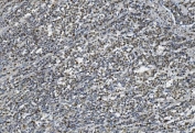 IHC staining of FFPE human gastric cancer with TKT antibody. HIER: boil tissue sections in pH8 EDTA for 20 min and allow to cool before testing.