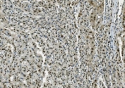 IHC staining of FFPE human liver cancer with TKT antibody. HIER: boil tissue sections in pH8 EDTA for 20 min and allow to cool before testing.