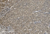 IHC staining of FFPE human lung cancer with U2AF65 antibody. HIER: boil tissue sections in pH8 EDTA for 20 min and allow to cool before testing.