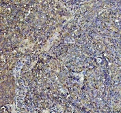 Argonaute 3 Antibody Cervical Carcinoma IHC. Immunohistochemistry analysis of FFPE human cervical carcinoma tissue stained with Argonaute 3 antibody detecting AGO3. Tumor cells show cytoplasmic staining with variable intensity and focal nucleoplasmic signal, consistent with AGO3 localization in RISC-associated complexes involved in RNA silencing and post-transcriptional gene regulation. The staining highlights malignant epithelial regions, while stromal components show comparatively reduced signal. Hematoxylin counterstain highlights nuclei in blue. HIER: boil tissue sections in pH 8 EDTA for 20 min and allow to cool before testing.