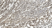 IHC staining of FFPE human pancreatic cancer with hnRNP H3 antibody. HIER: boil tissue sections in pH8 EDTA for 20 min and allow to cool before testing.