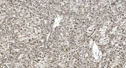 IHC staining of FFPE human liver cancer with hnRNP H3 antibody. HIER: boil tissue sections in pH8 EDTA for 20 min and allow to cool before testing.