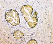 PSA Antibody Rabbit Polyclonal IHC staining of human prostate cancer. Immunohistochemistry analysis of FFPE human prostate carcinoma using PSA Antibody Rabbit Polyclonal shows strong HRP-DAB brown cytoplasmic staining in malignant glandular epithelial cells, consistent with Prostate specific antigen (KLK3) expression in prostate-derived tumor cells, while surrounding stromal cells remain largely negative. HIER: tissue sections were boiled in pH 8 EDTA buffer for 20 minutes and allowed to cool before testing.