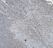 IHC staining of FFPE human adrenocortical adenoma tissue with PDIR antibody. HIER: boil tissue sections in pH8 EDTA for 20 min and allow to cool before testing.